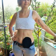 Foto: junge Stomaträgerin mit kleinem schwarzen Beutel am Bauch
