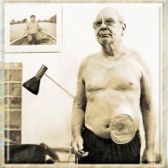 Foto: Mann mit kleinem Beutel am linken unteren Bauch