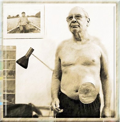 Foto: Mann mit kleinem Beutel am linken unteren Bauch