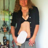 Foto: Stomaträgerin zeigt ihren Beutel am Bauch... und noch ein bisschen mehr ;-)