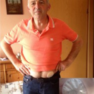Foto: Stomaträger zeigt seine Stoma-Kappe am Bauch, wie sie nach einer Irrigation getragen wird