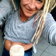 Foto: Stomaträgerin trägt bauchfrei und zeigt ihren Beutel am Bauch