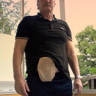 Foto: Stomaträger zeigt seinen Beutek am Bauch