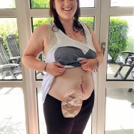 Foto: junge Stomaträgerin zeigt nach ihrer Schwangerschaft ihren Beutel am Bauch