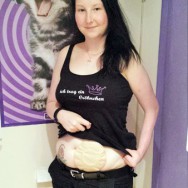 Foto: Stonaträgerin zeigt ihre Stomakappe am Bauch