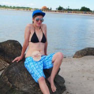 Foto: Stomaträgerin im Bikini zeigt ihren Stomabeutel am Bauch