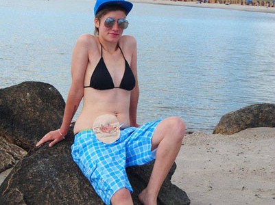 Foto: Stomaträgerin im Bikini zeigt ihren Stomabeutel am Bauch