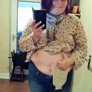Foto: Stoimaträgerin zeigt ihren Stomabeutel am Bauch
