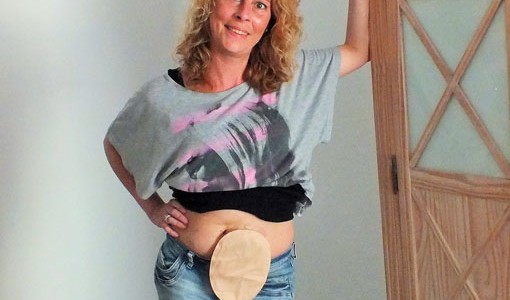 Foto: Junge Frau zeigt ihren Stomabeutel am Bauch