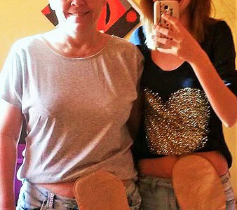 Foto: Mutter und Tochter zeigen gemeinsam ihren Stoma-Beutel