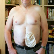 Foto: Stomaträger zeigt sich mit seinem Kolostoma-Beutel am Bauch