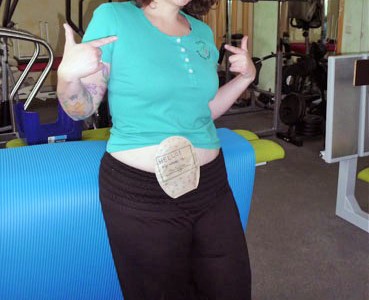 Foto: Physiotherapeutin zeigt ihren Stomabeutel am Bauch
