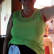 Foto: Stomaträgerin zeigt ihren Beutel am Bauch